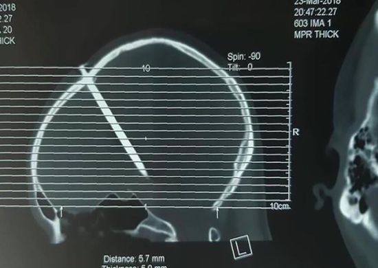 Médico encontra prego de sete centímetros cravado na cabeça de idoso