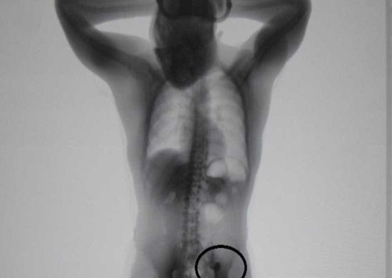 Raio-x mostra alianças engolidas por ladrão