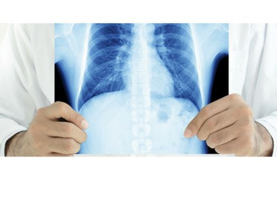 Anvisa aprova nova combinação de drogas para câncer de pulmão