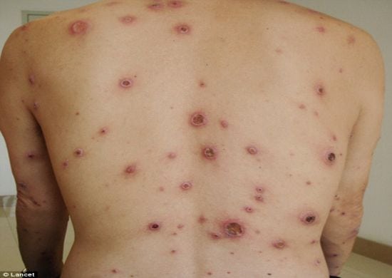 Doença pouco conhecida causa alarme por resistência a antibióticos