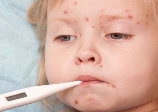 Total de casos de sarampo já é o maior desde 1999