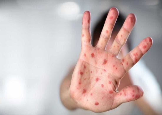 Brasil tem 2.044 casos confirmados de sarampo