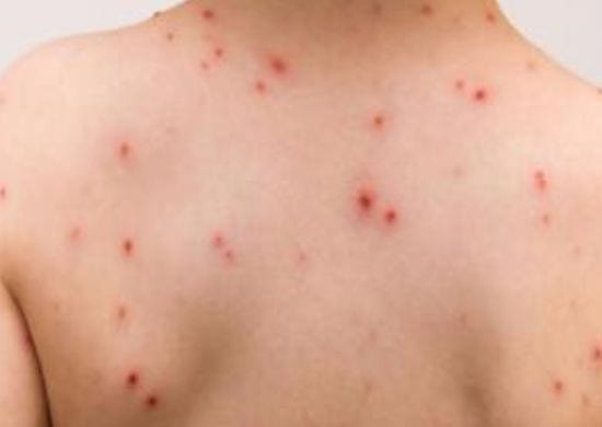 Brasil tem 2.192 casos de sarampo confirmados