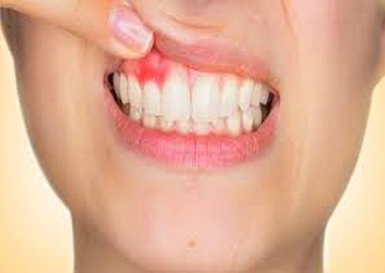 Lesões na boca que não cicatrizam podem ser sinais de câncer