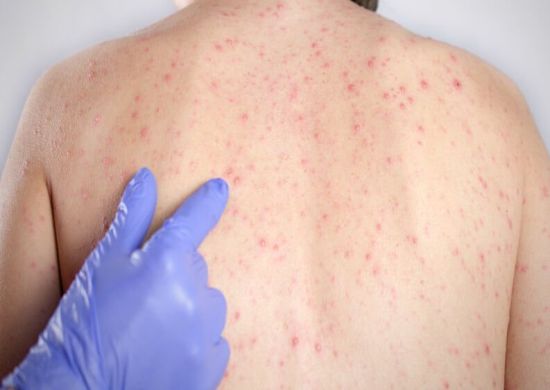 Saúde disponibiliza vitamina A para tratamento de sarampo