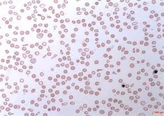 SUS garante tratamento de paciente com anemia crônica