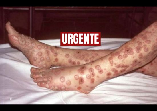 Porto Alegre investiga 1º caso suspeito de varíola dos macacos no Brasil