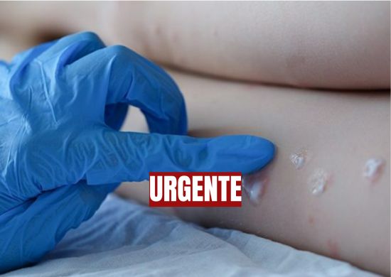 Ministério da Saúde confirma 3° caso da varíola dos macacos no Brasil