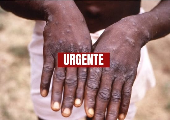 Cidade de SP investiga caso suspeito de varíola dos macacos