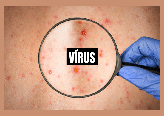 Japão emite alerta de nível 1 para surto global de varíola dos macacos