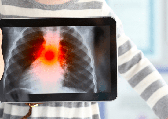 Guarulhos inicia mutirão de exame de detecção de doenças pulmonares pelo Cemeg Pimentas