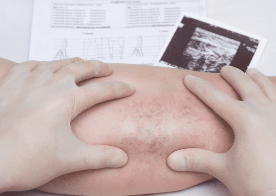 Estudo aponta que trombose causa 165 internações diárias no Brasil