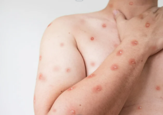 Brasil supera marca de mil casos de mpox em 2024