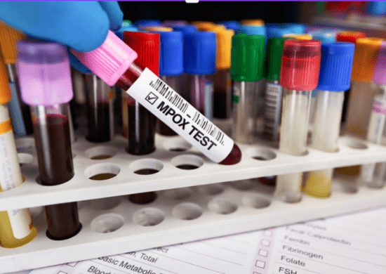 Surto de mpox avança na África: 30 mil casos suspeitos e apoio financeiro do Banco Mundial