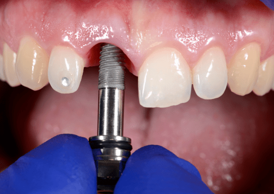 UNG abre agenda para avaliações odontológicas e implantes dentários